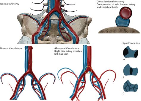 side lying iliac compression test|right common iliac vein compression.